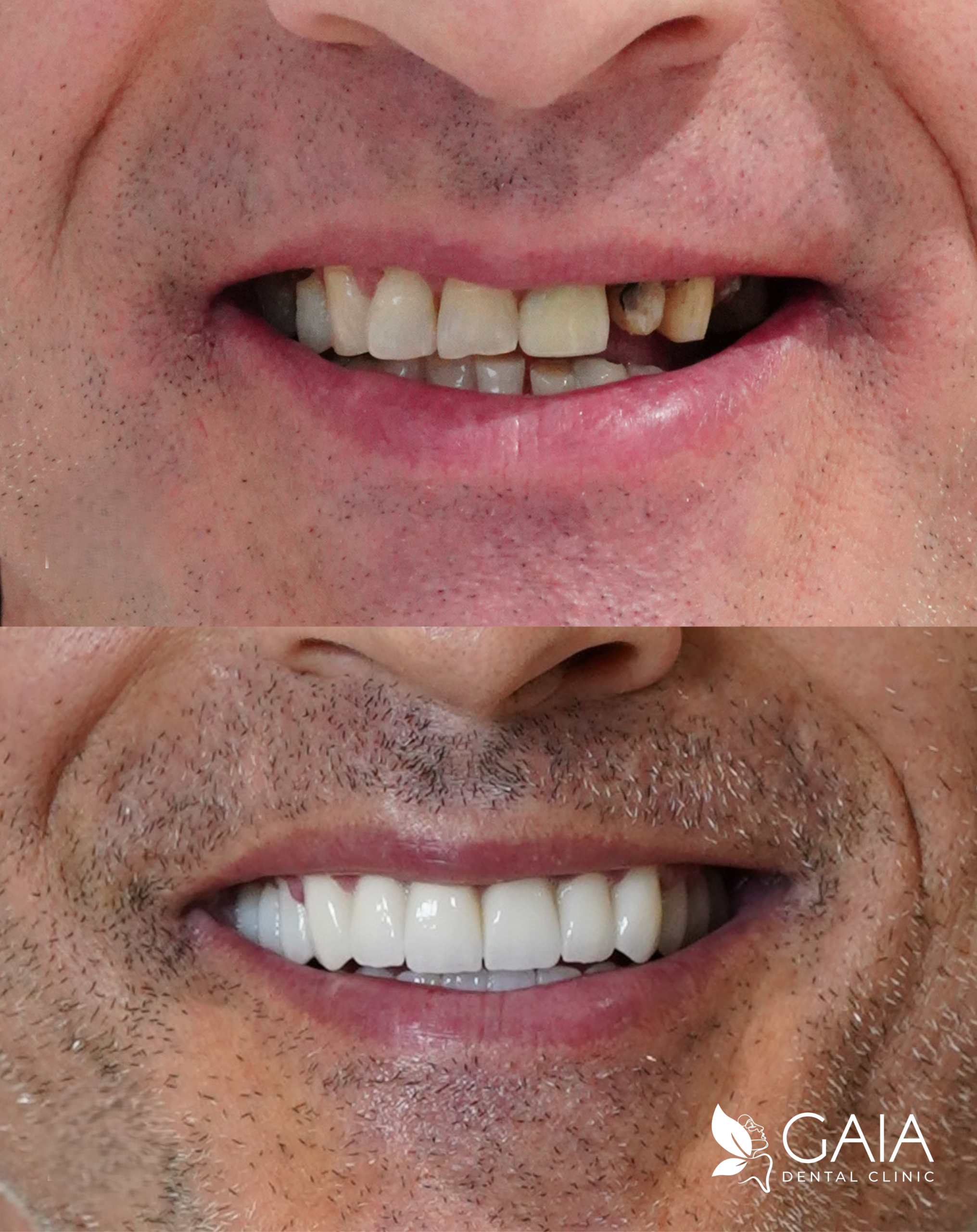 Prima e Dopo - Gaia Clinic